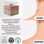 Parches para eliminar verrugas sin dolor